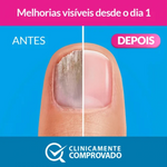 Excilor Forte Verniz Fungos Unhas 30ml